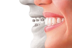 invisalign profile